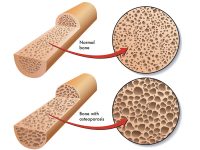 osteoporosis-bone
