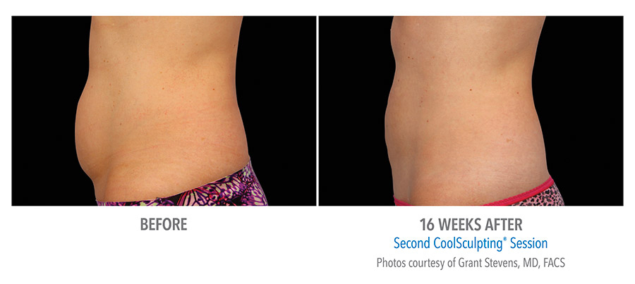 coolsculpting_female_before_and_after