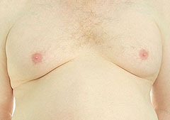 Male breasts